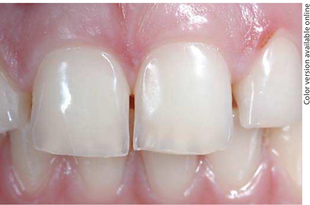 Tooth Index (PDF) A New Index of Tooth Wear