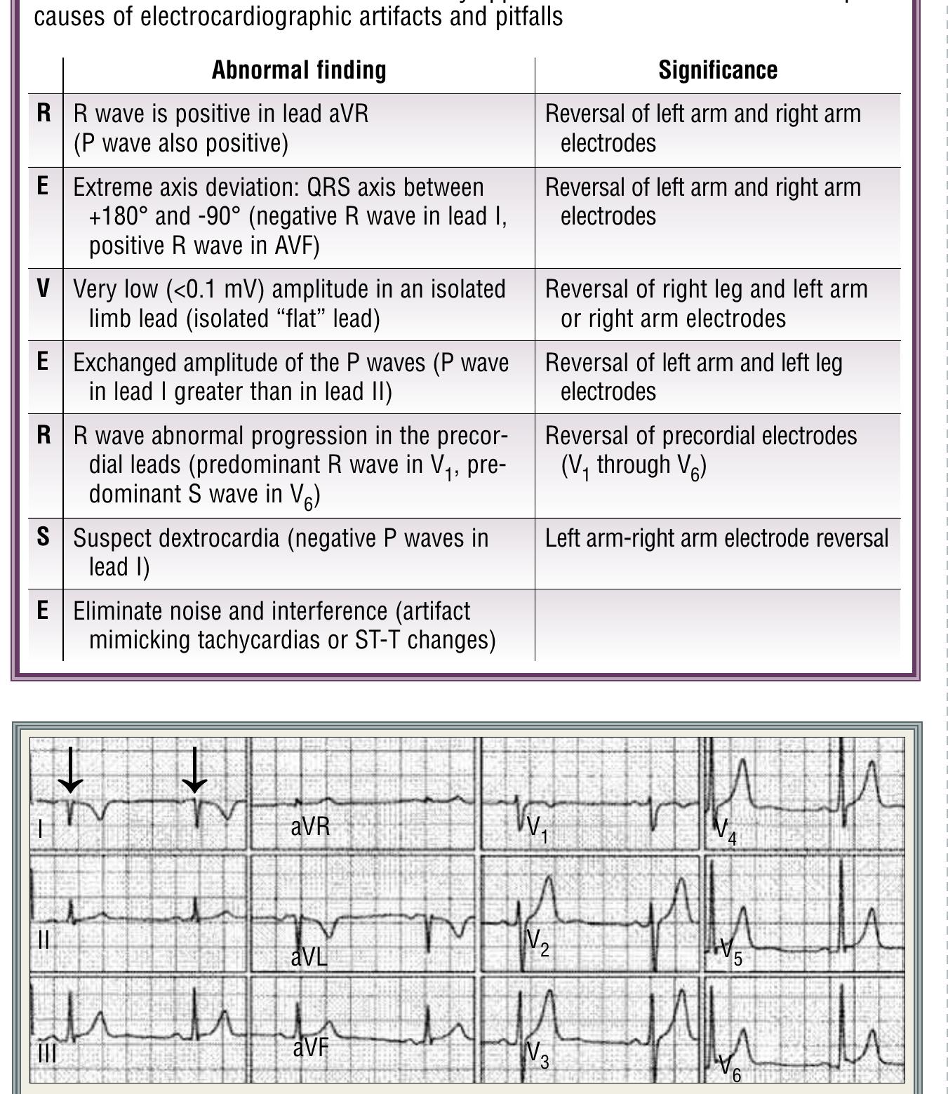 Figure 3 - from Electrocardiography Pitfalls and Artifacts: