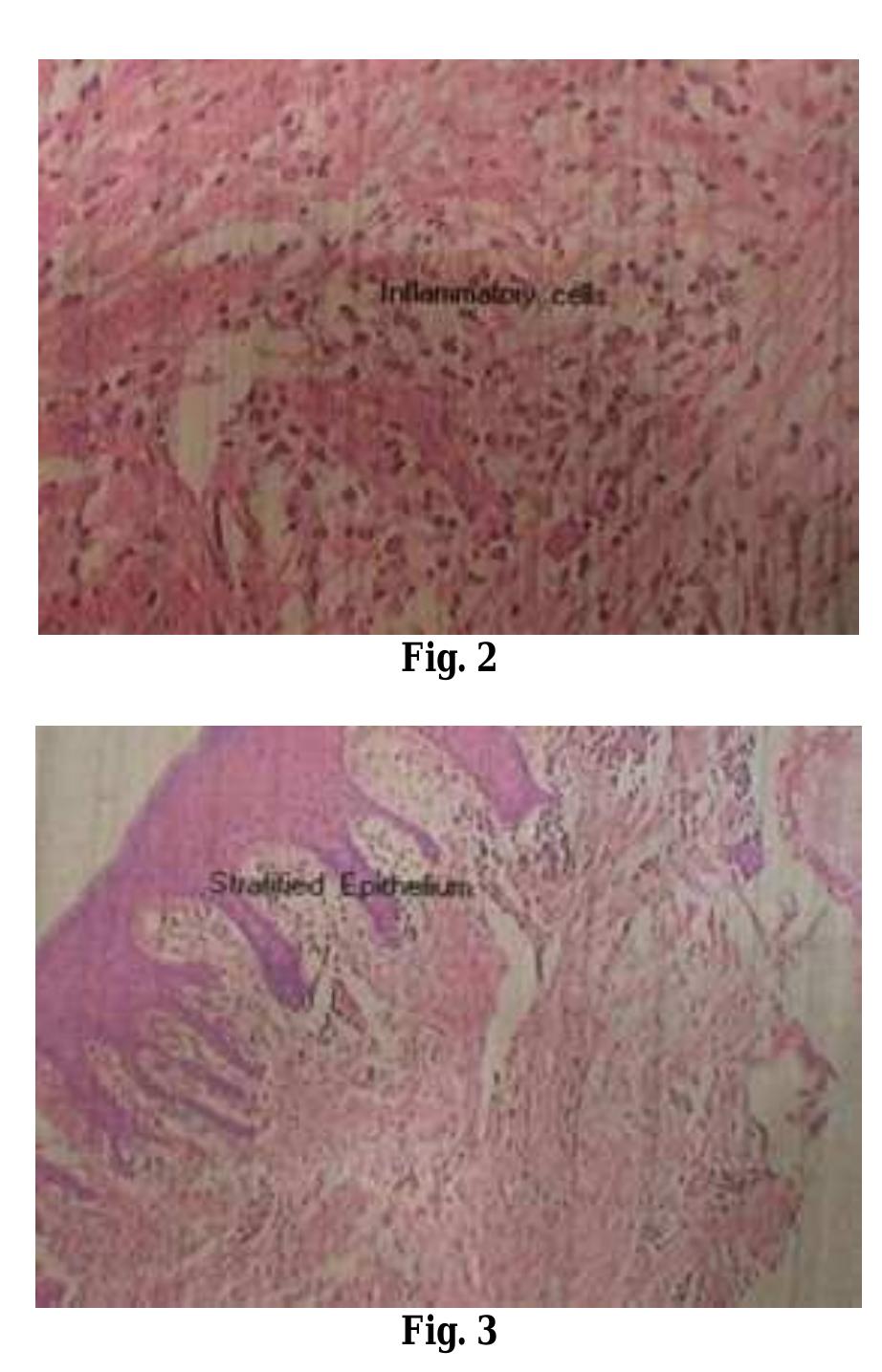 (PDF) Pyogenic Granuloma-A case report