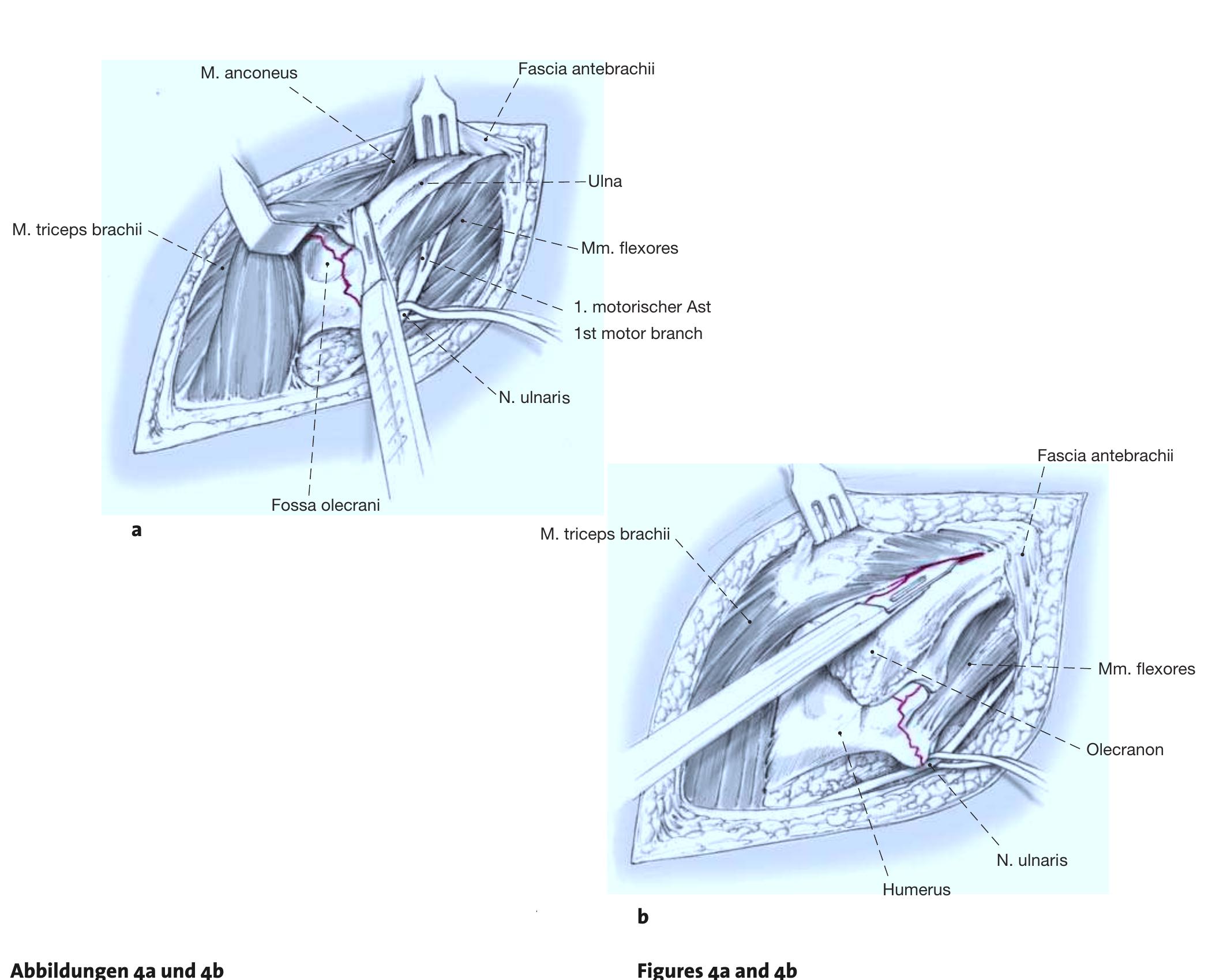 Elevation of medial full-thickness flap, releasing the