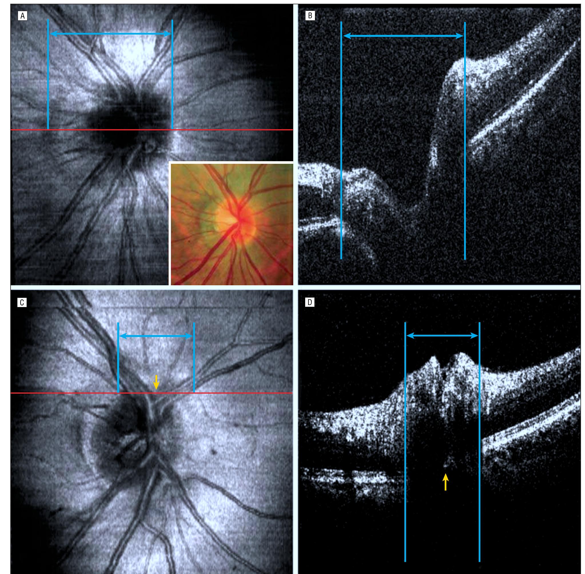 (PDF) Comparison of Optic Disc Margin Identified by Color Disc ...
