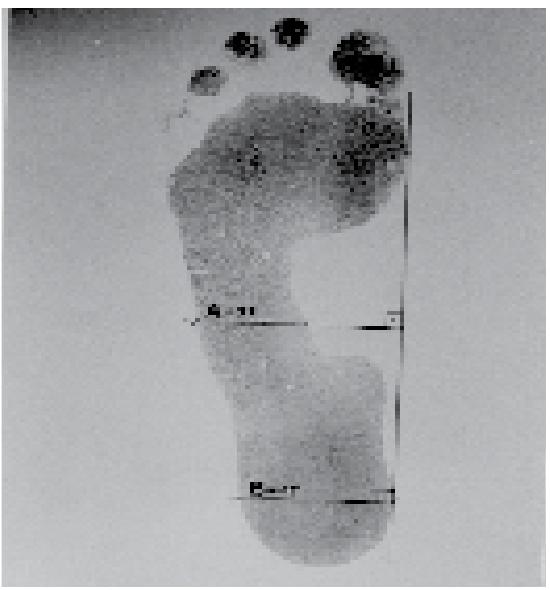 (PDF) CALCULATION OF STAHELI'S PLANTAR ARCH INDEX AND PREVALENCE OF ...