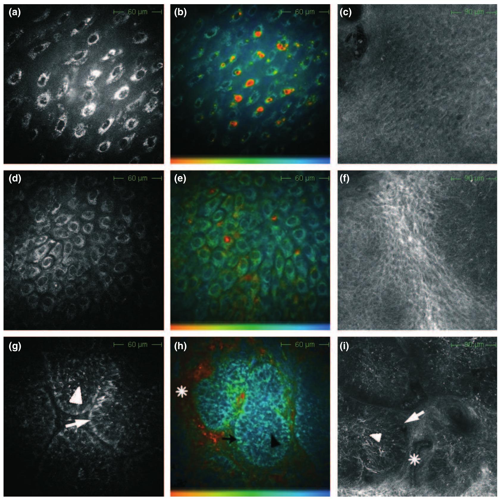 Tion Color (PDF) High-resolution imaging of basal cell carcinoma: a comparison ...