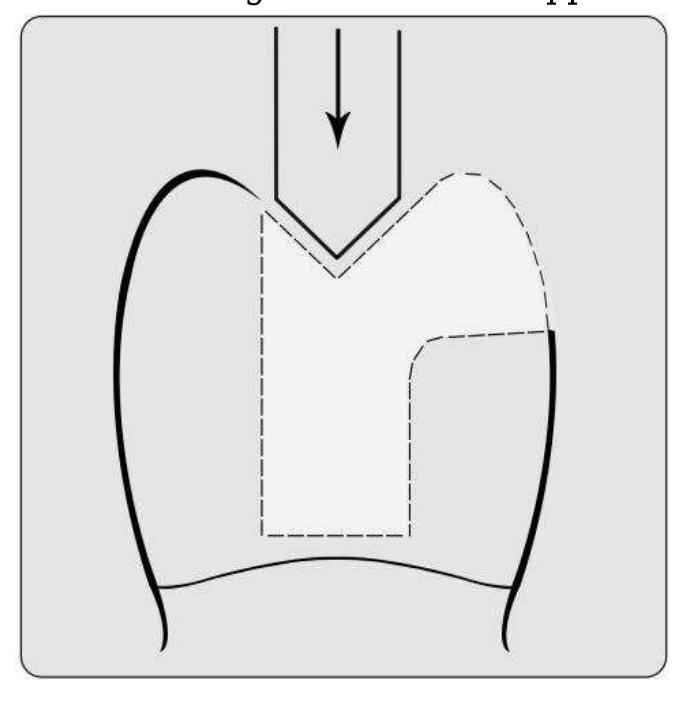 (PDF) Fracture Resistance and Failure Mode of Endodontically Treated ...