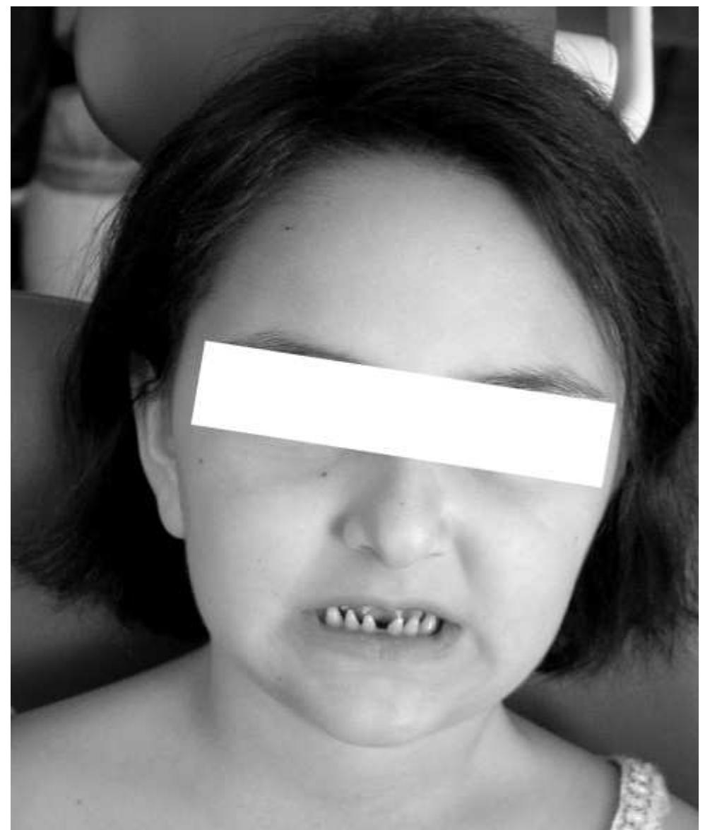Figure 1 - from Evaluation of Ectodermal Dysplasia