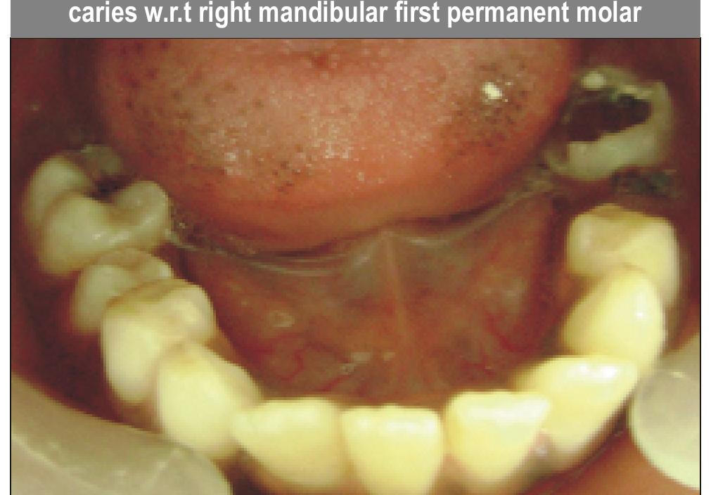 Pre-operative: intra—oral periapical radiograph of
