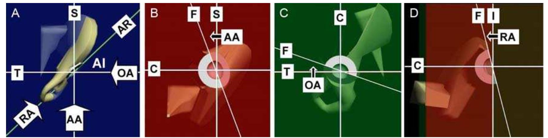 (PDF) Measurement of acetabular cup anteversion with the circle theorem