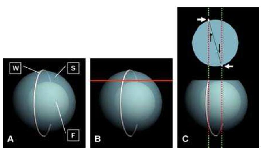 Figure 2 - Measurement of acetabular cup anteversion with
