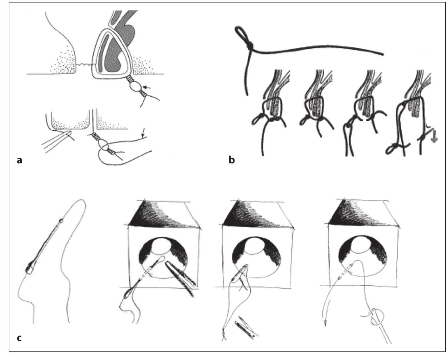 (PDF) Setons in the Treatment of Anal Fistula: Review of Variations in ...