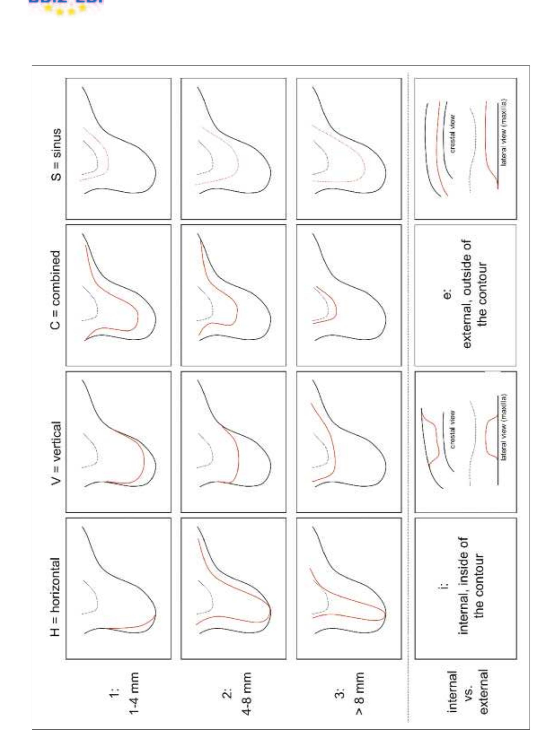 Figure 3 - Cologne Classification of Alveolar Ridge Defects