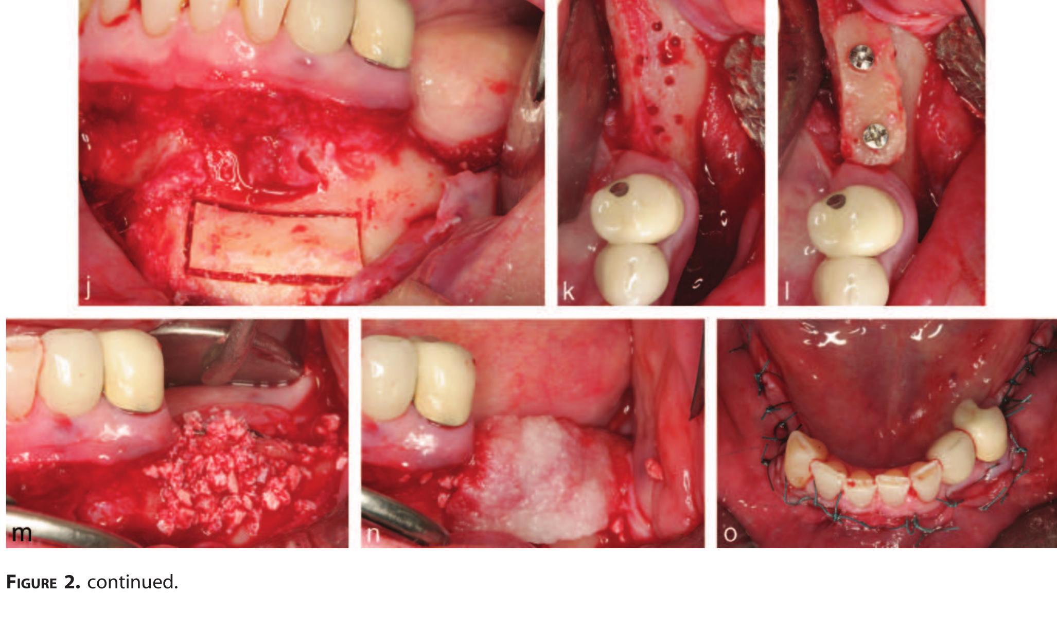 (PDF) Bilateral Vertical Ridge Augmentation With Block Grafts and ...