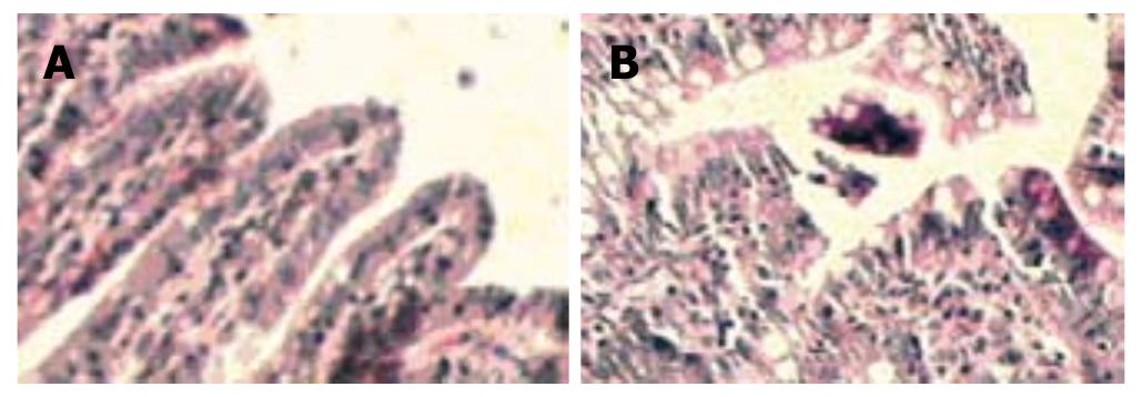 PDF) Lipoma induced jejunojejunal intussusception