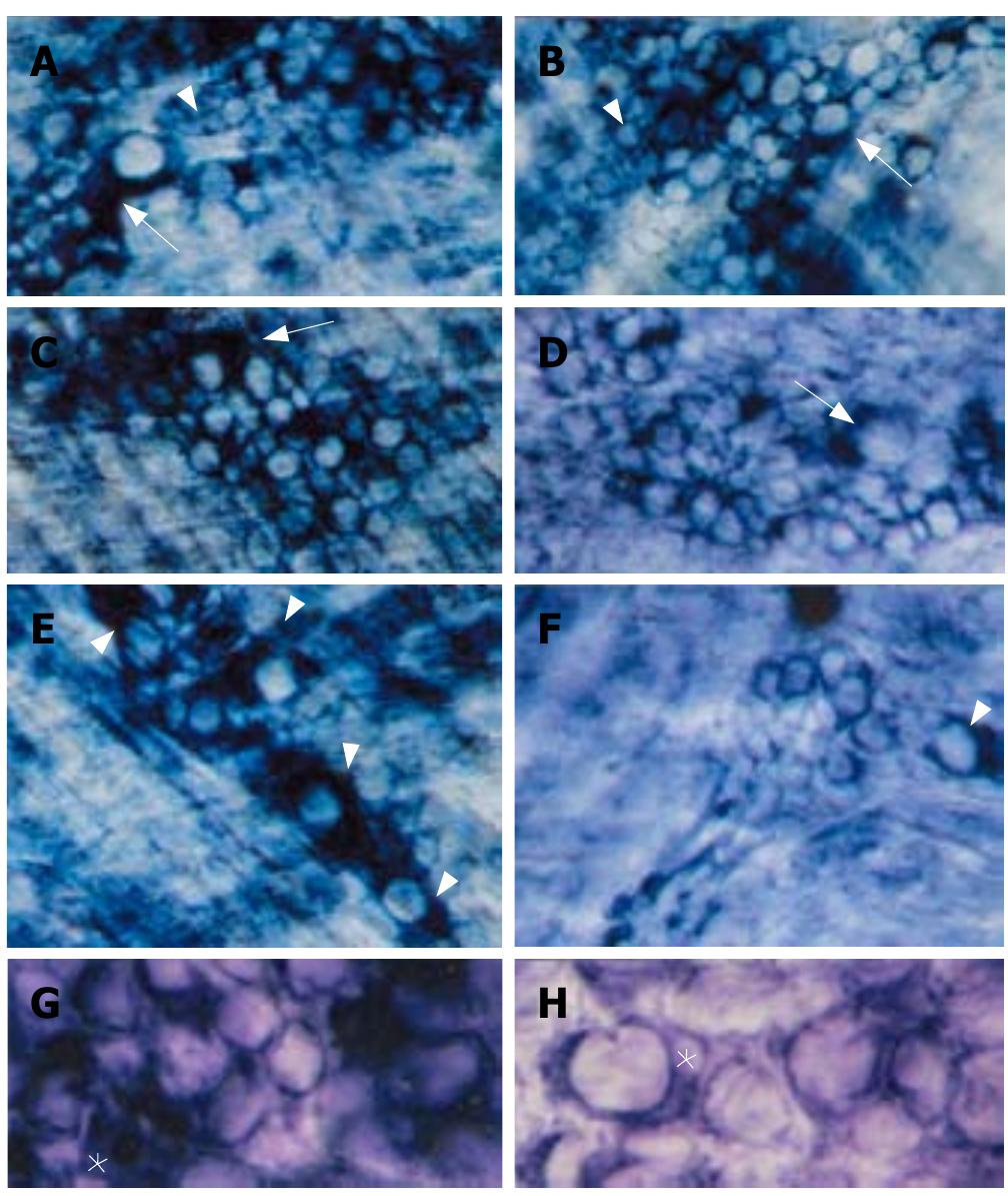 PDF) Lipoma induced jejunojejunal intussusception