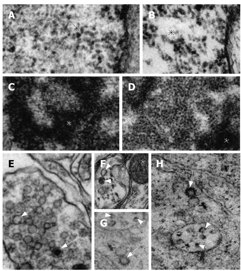 PDF) Lipoma induced jejunojejunal intussusception