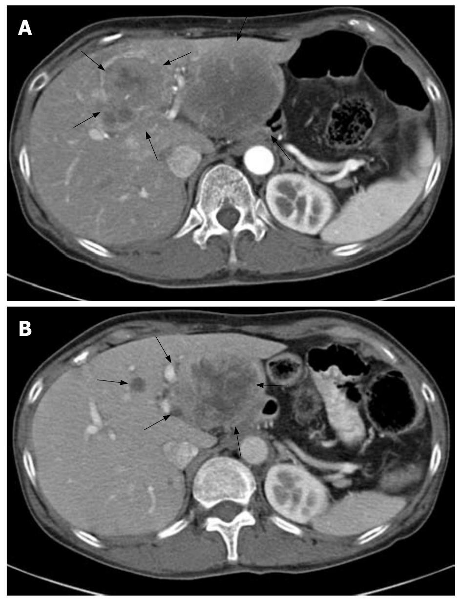 PDF) Lipoma induced jejunojejunal intussusception