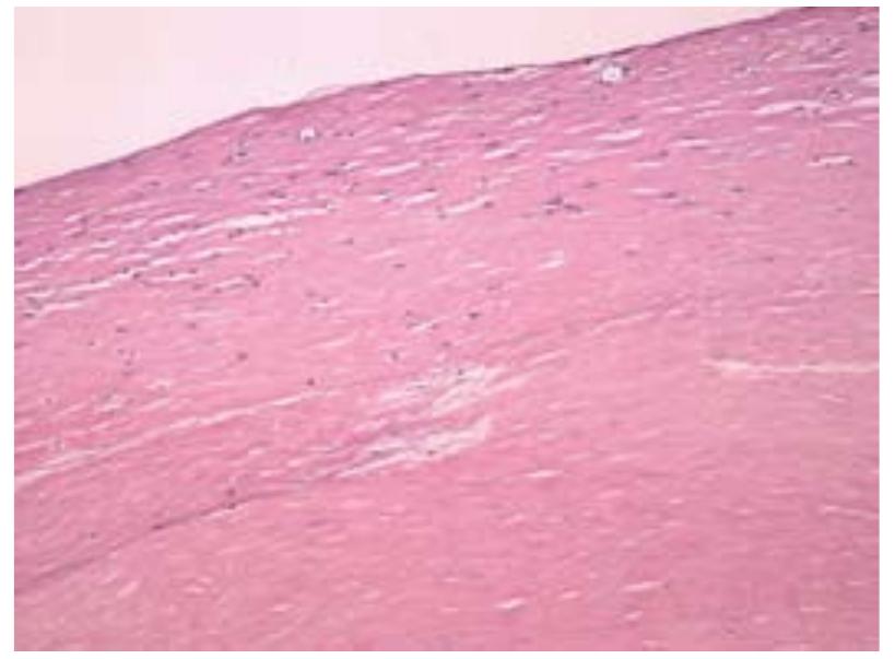 PDF) Lipoma induced jejunojejunal intussusception
