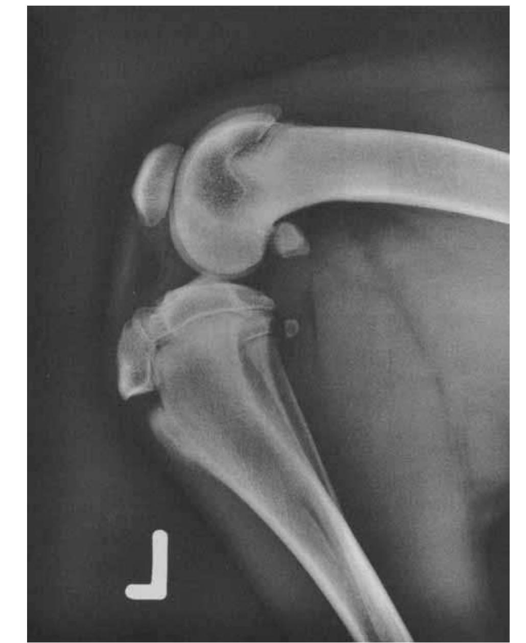 Figure 1 From Avulsion Of The Popliteus Muscle In A figure-1-from-avulsion-of-the-popliteus-muscle-in-a