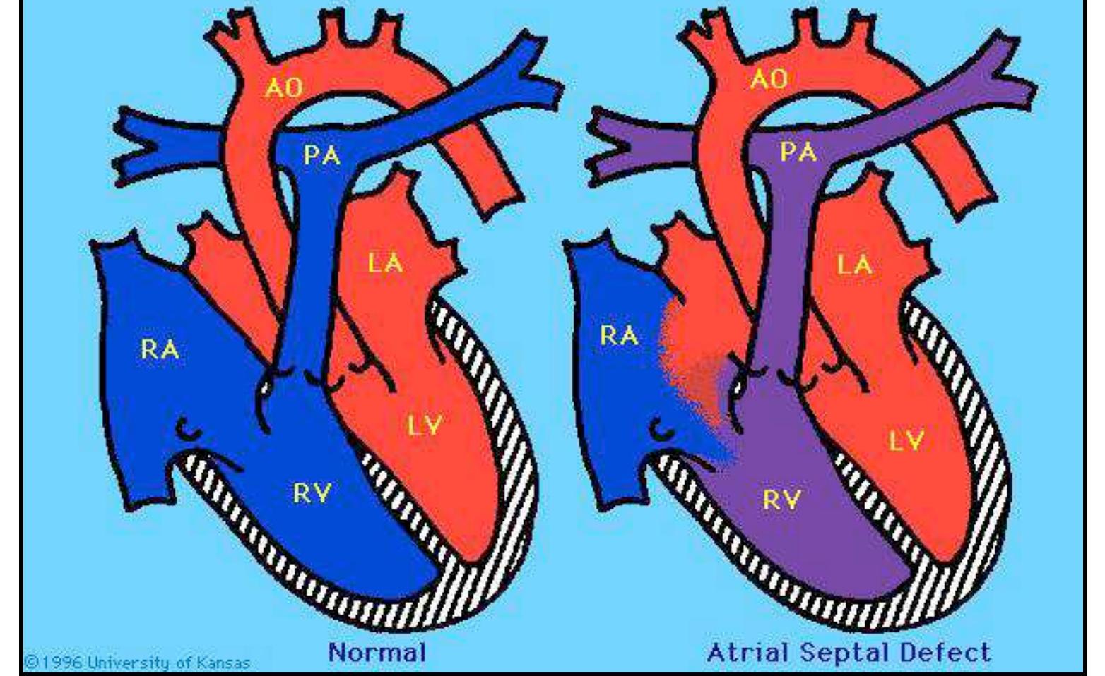 (PDF) Congenital Heart Defects