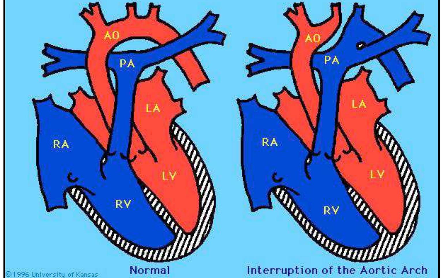 (PDF) Congenital Heart Defects