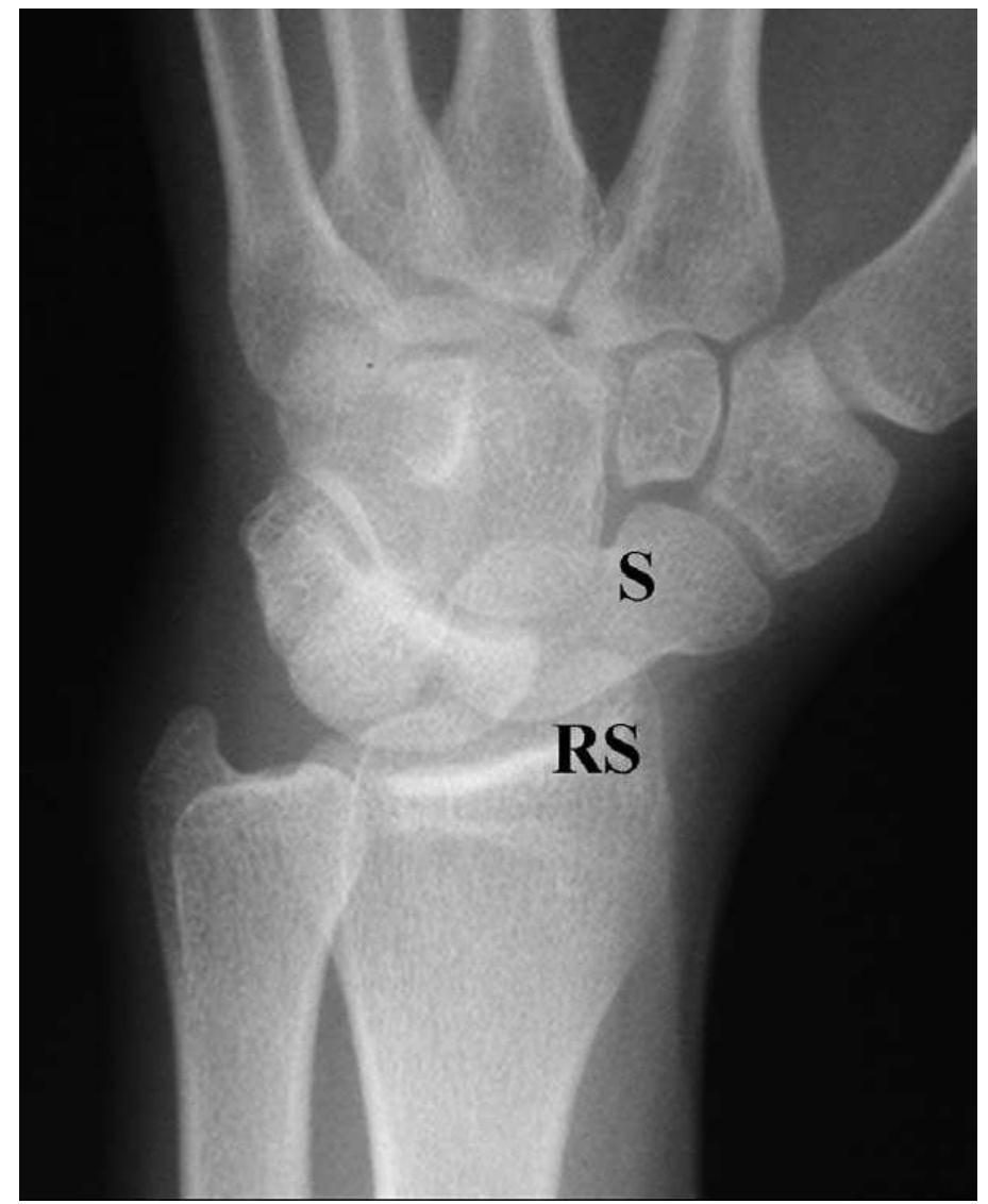 (PDF) Radiographic Evaluation of the Wrist: A Vanishing Art