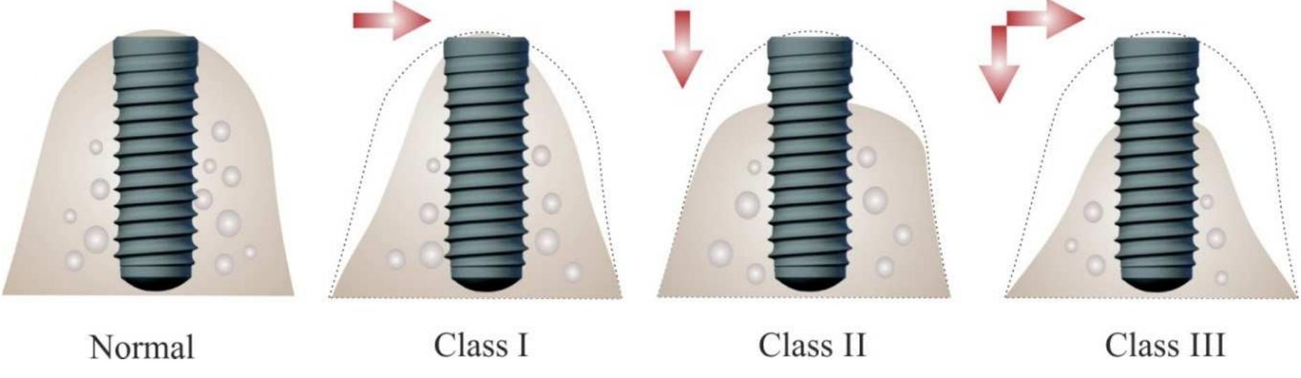 Siberet Ridge Defect (PDF) Bone Replacement Materials and Techniques Used for Achieving ...
