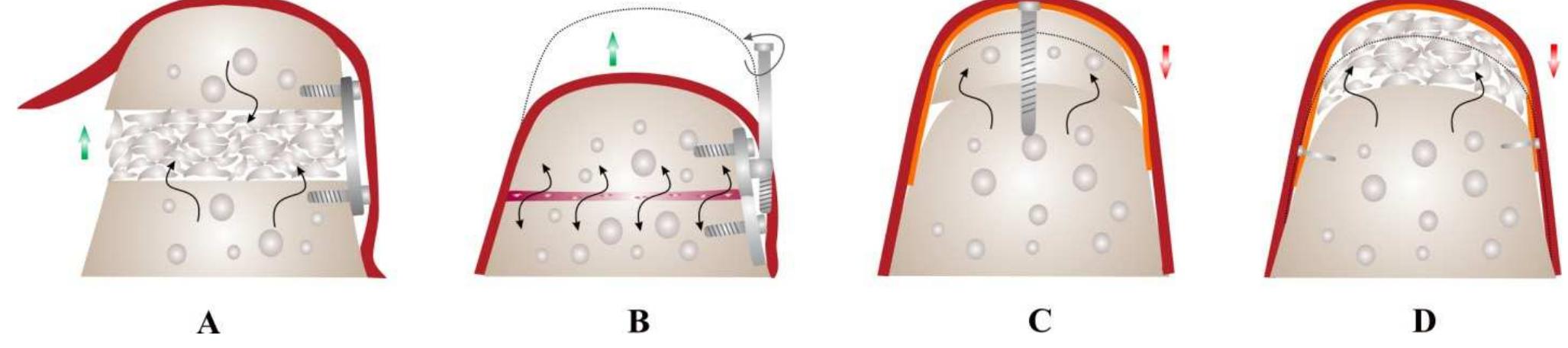 (PDF) Bone Replacement Materials and Techniques Used for Achieving ...