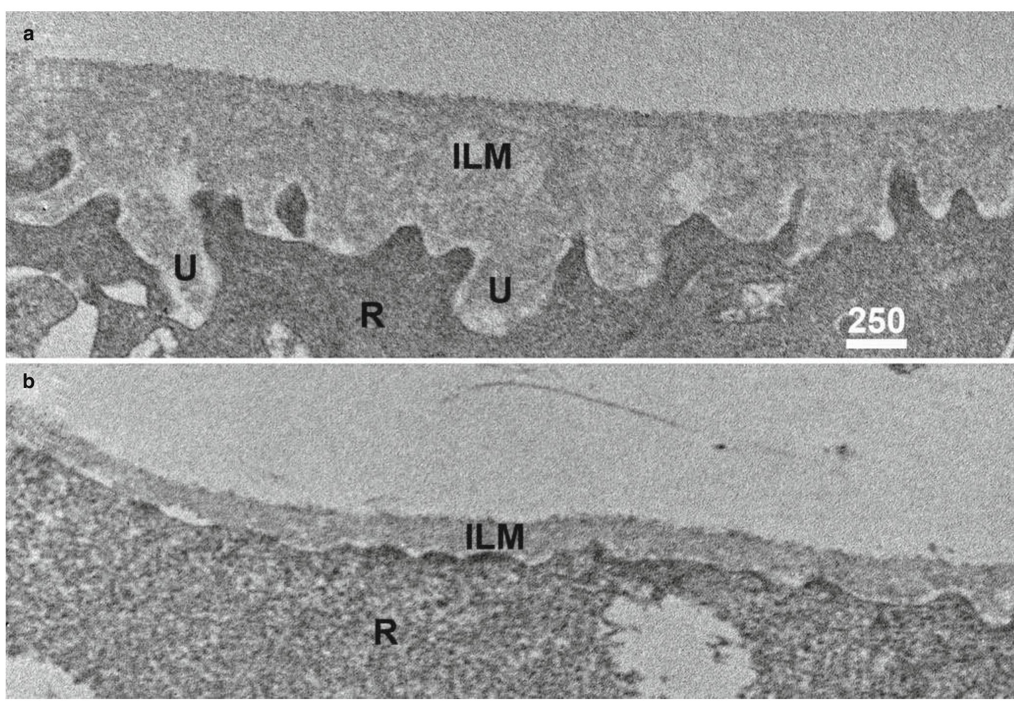 Interillum (PDF) II.E. Vitreoretinal Interface and Inner Limiting Membrane