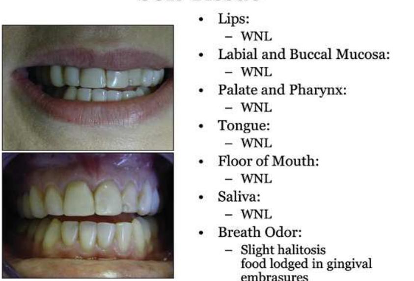 Embrasures, incisal, gingival, facial, and lingual have been