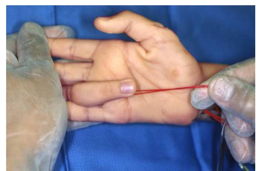 A 7-year-old child’s status after left humerus fracture with