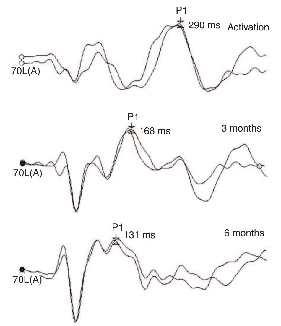 (PDF) Development of P1 cortical auditory evoked potential in children ...