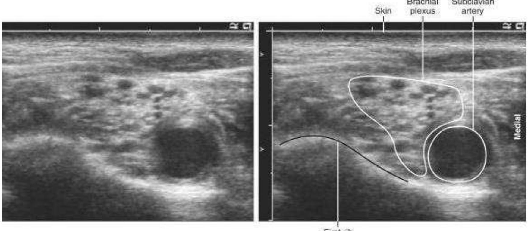 Once brachial plexus is identified, group dx patients