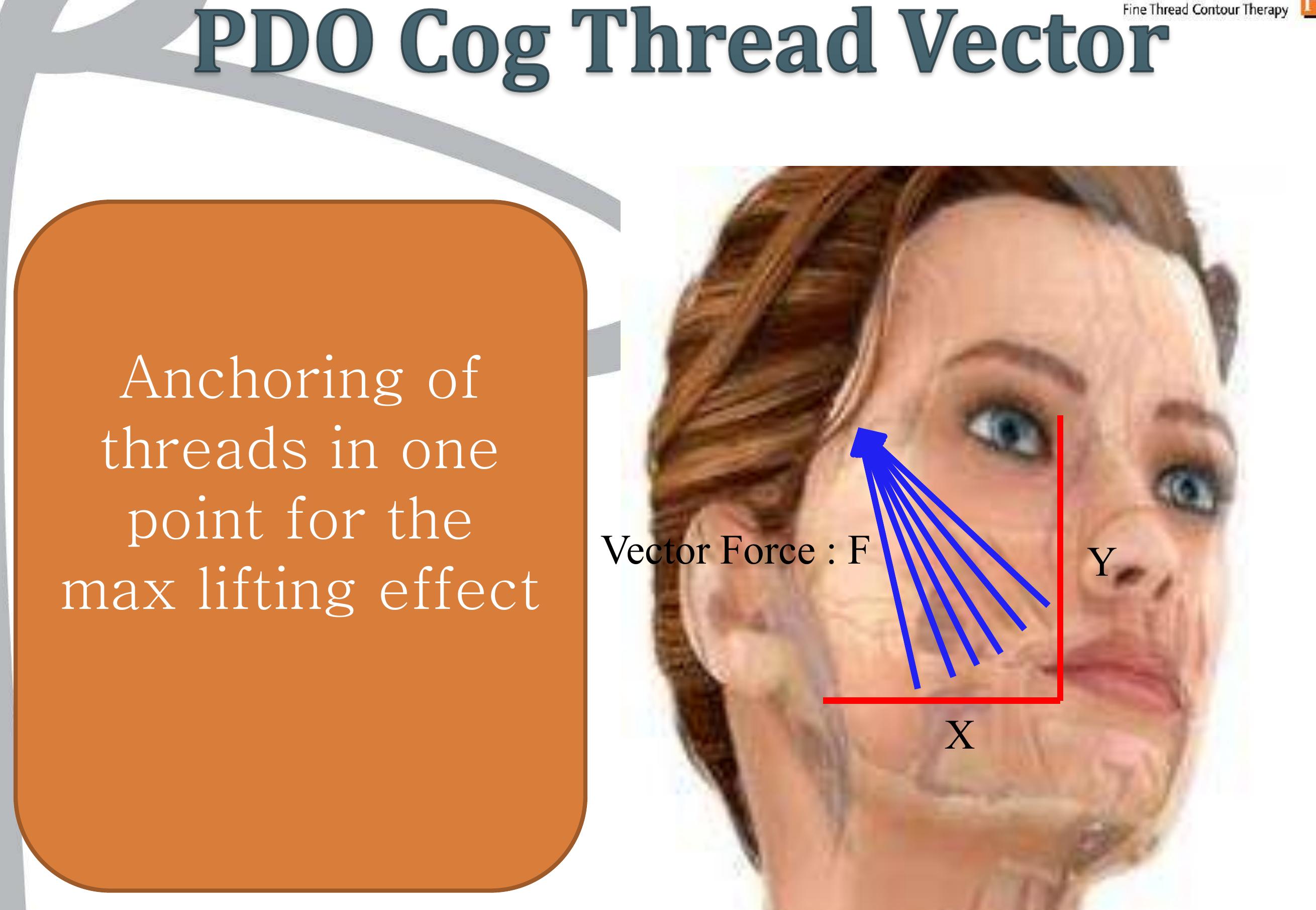Figure 1 - Anchoring of threads in one point for the max