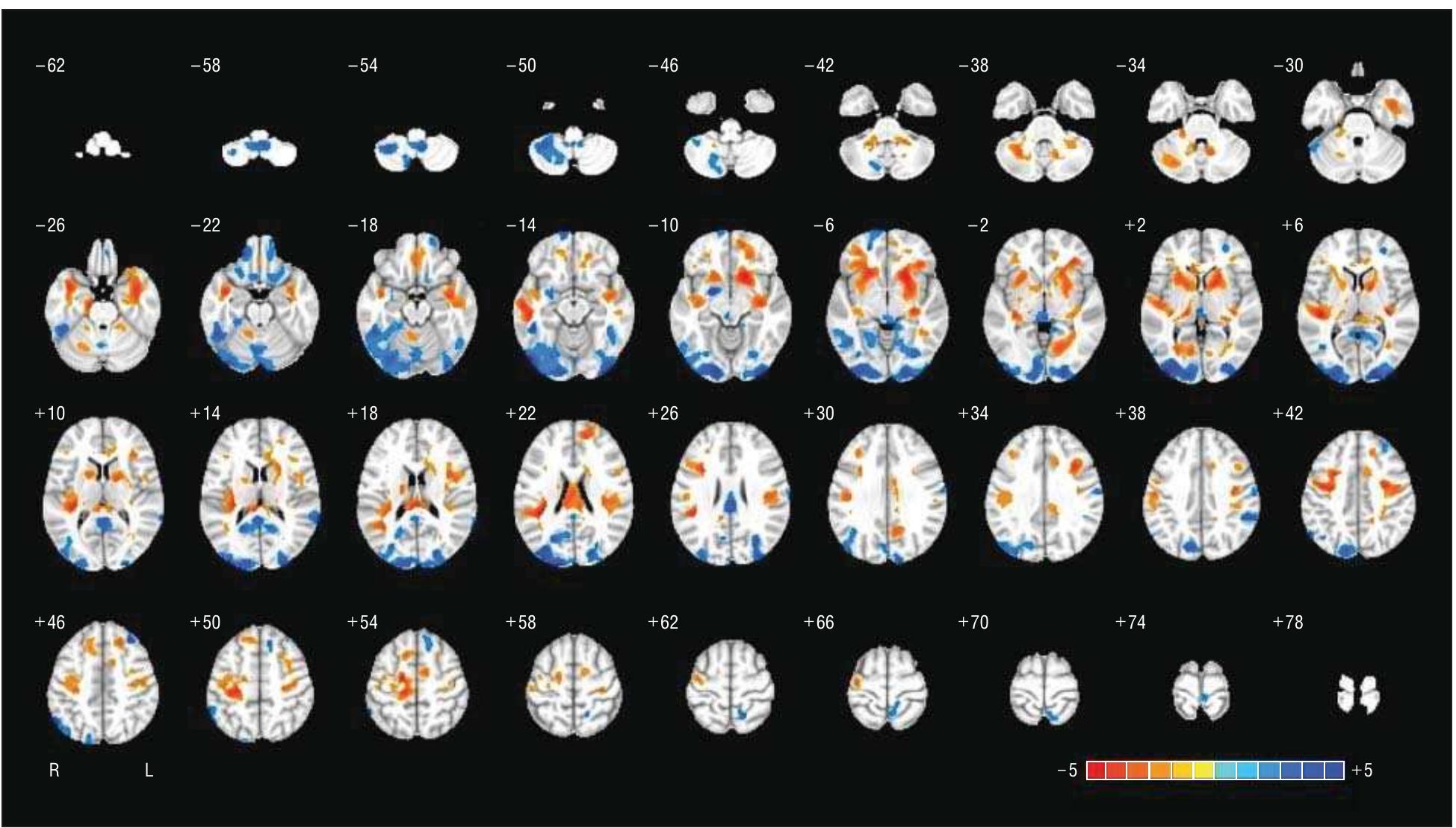 Brain map (partial least-squares analysis) illustrating
