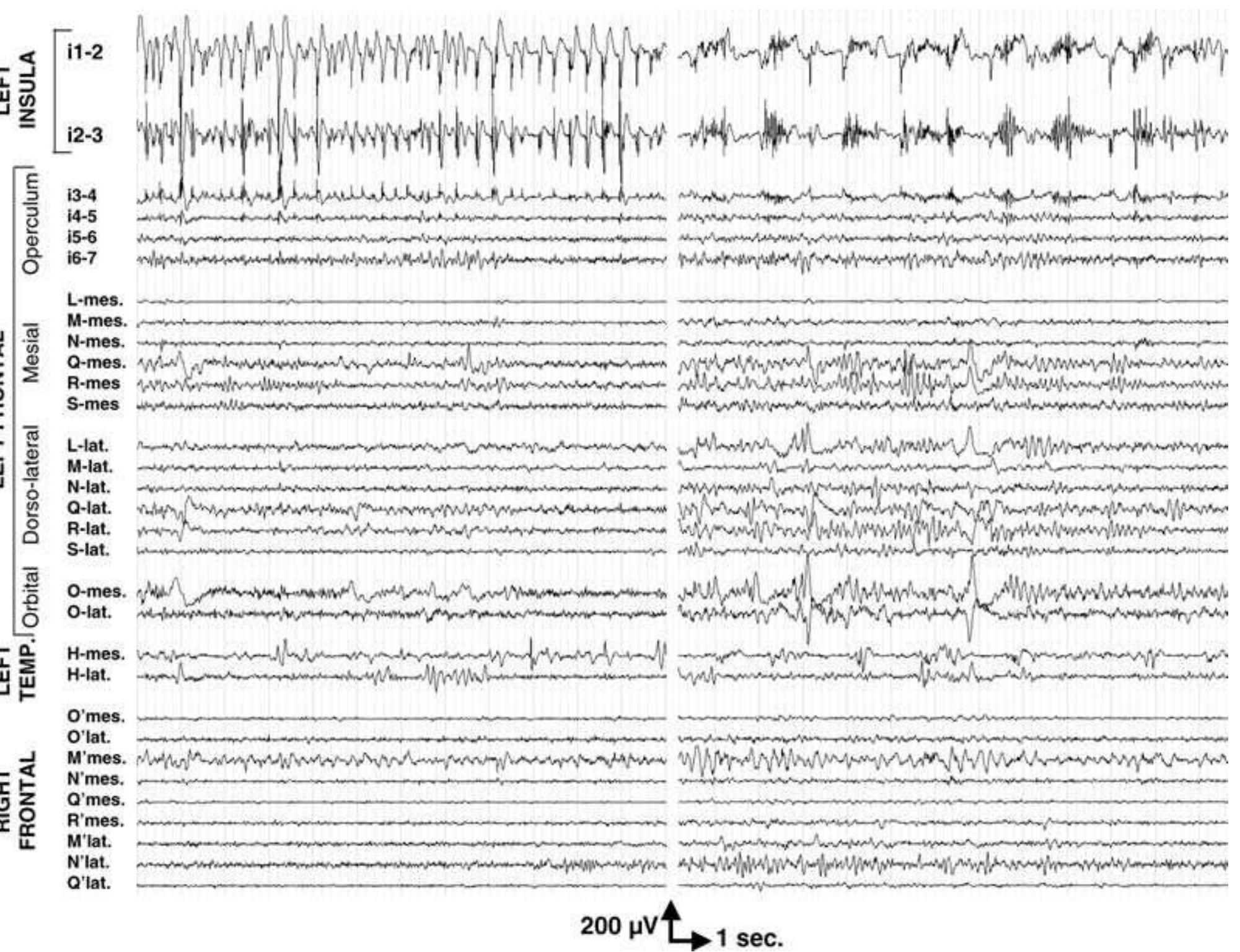 Interictal intracerebral eeg abnormalities. patient 3 showed