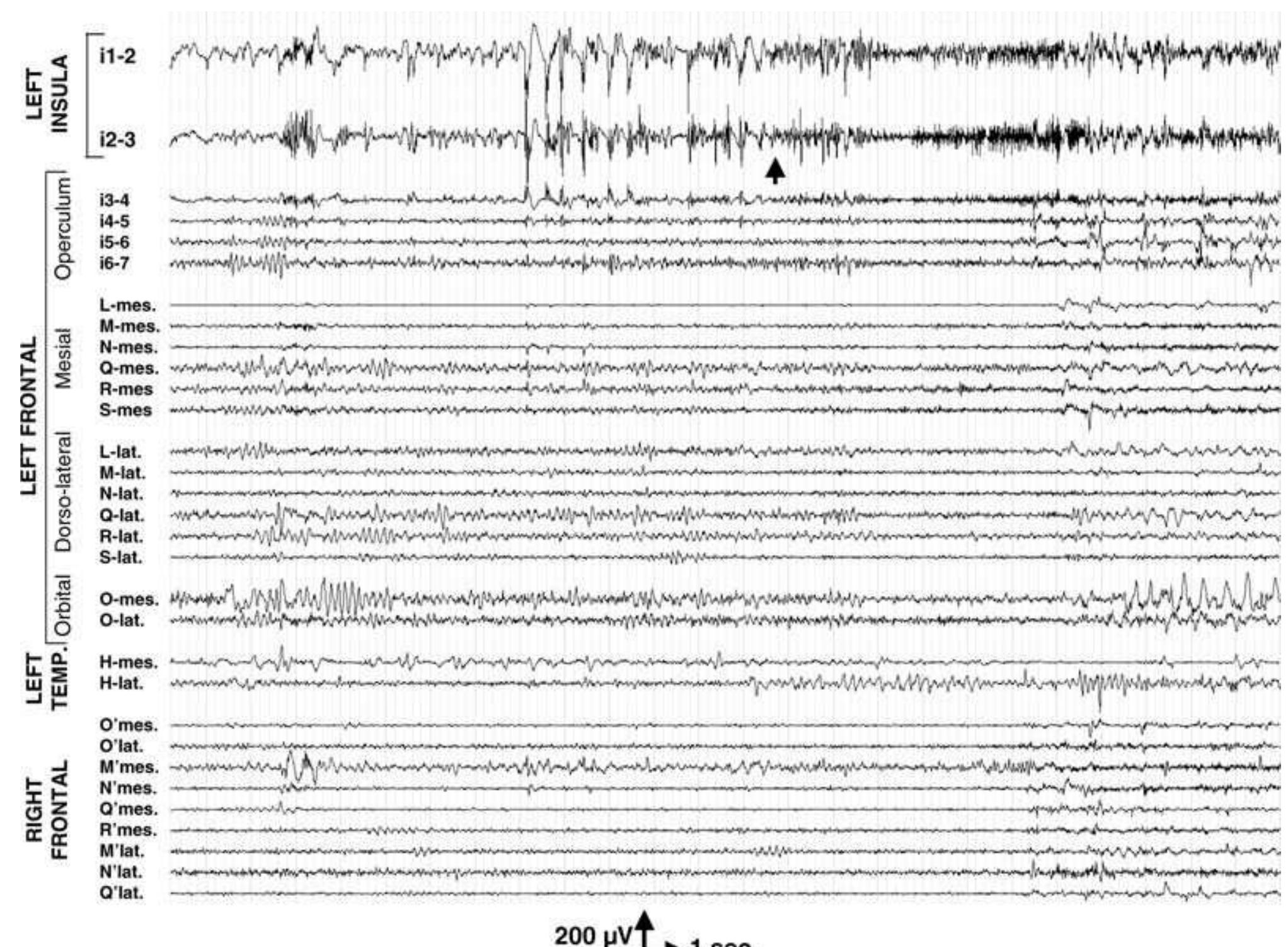 Interictal intracerebral eeg abnormalities. patient 3 showed