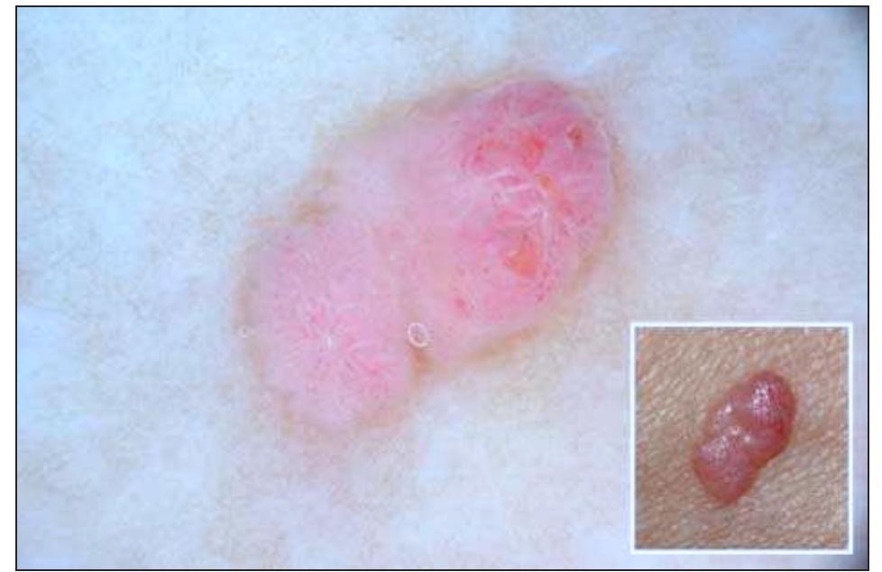 Fep Derm (PDF) Dermoscopy Patterns of Fibroepithelioma of Pinkus