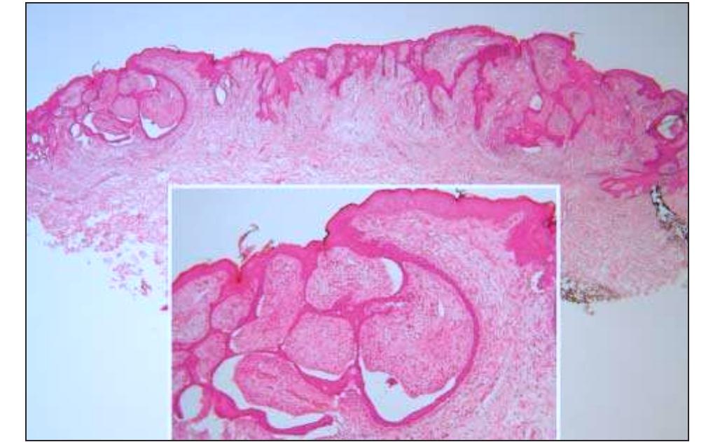 Fep Derm (PDF) Dermoscopy Patterns of Fibroepithelioma of Pinkus