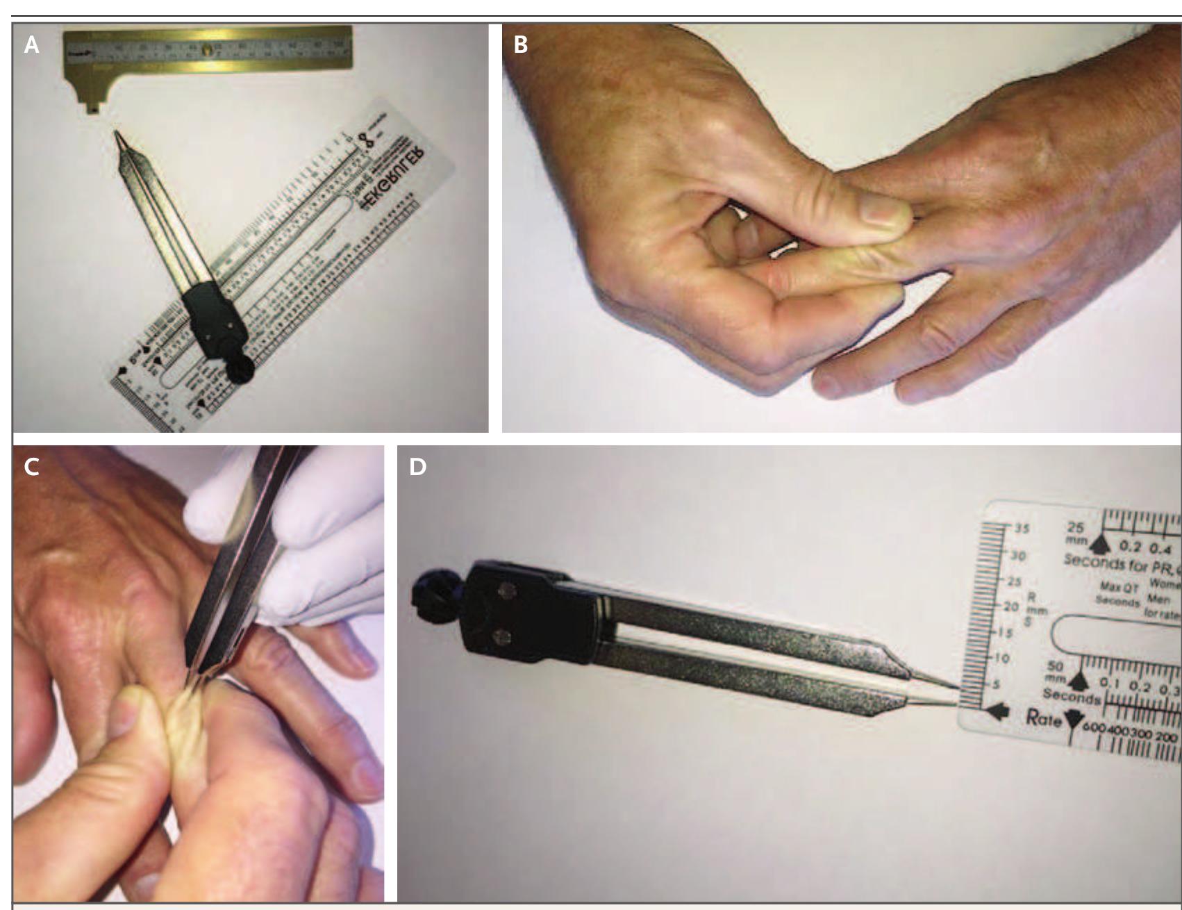 (PDF) Diagnosis and Differential Diagnosis of Cushings Syndrome