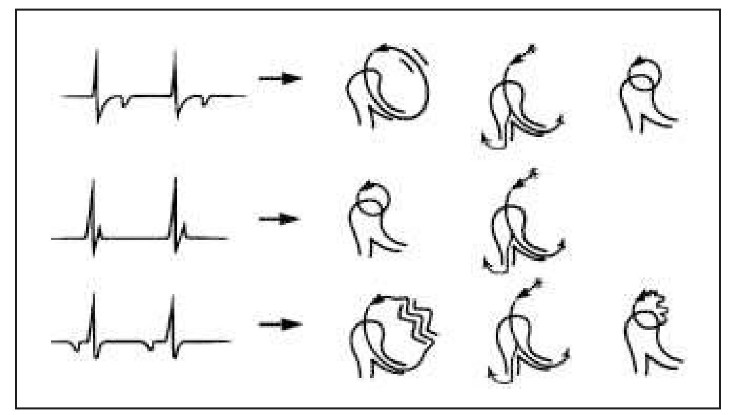 (PDF) Supraventricular Tachycardia: Diagnosis and Management