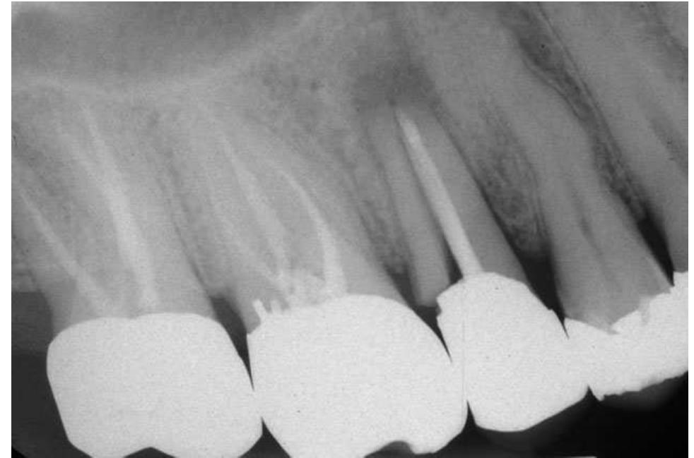 Figure 16 - from Restoration of endodontically treated