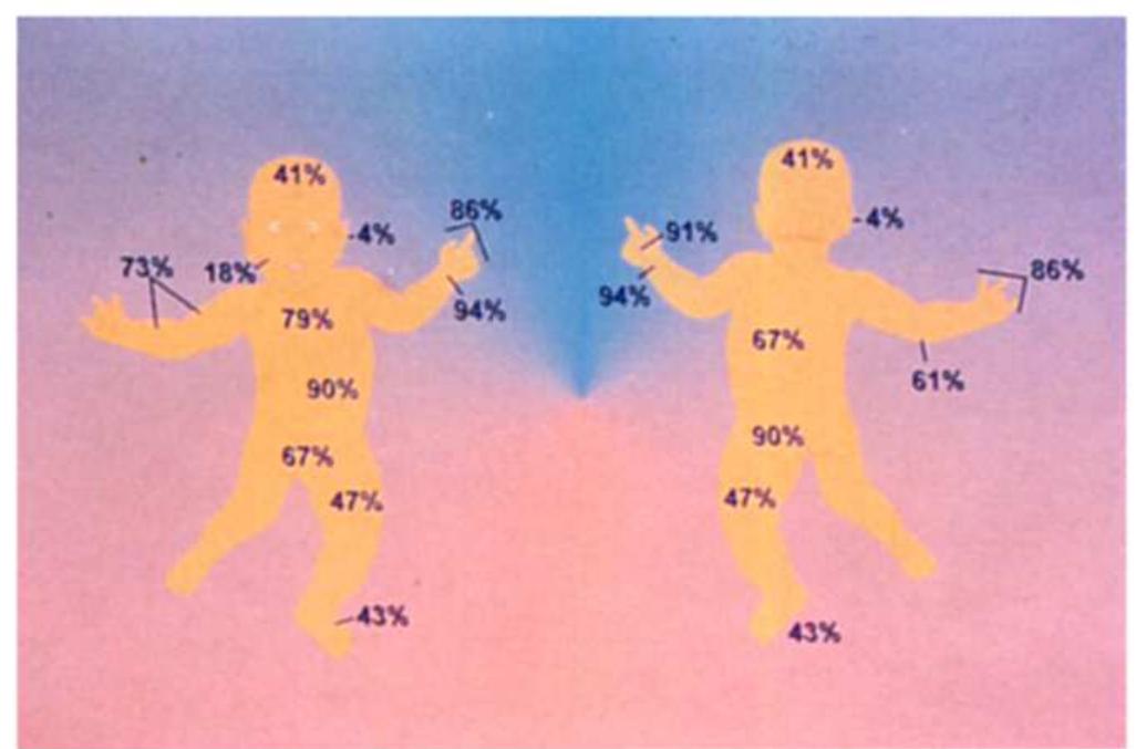 Scabies Body Distribution Figure 32 - from Infestations