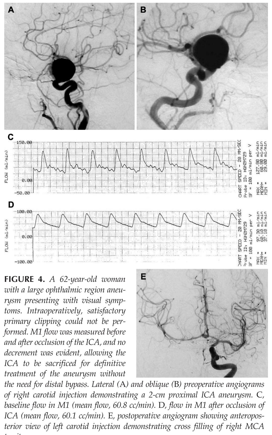 (PDF) The Utility of Intraoperative Blood Flow Measurement During ...