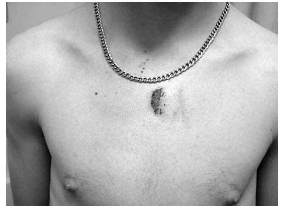 (PDF) Plastic baton round injuries