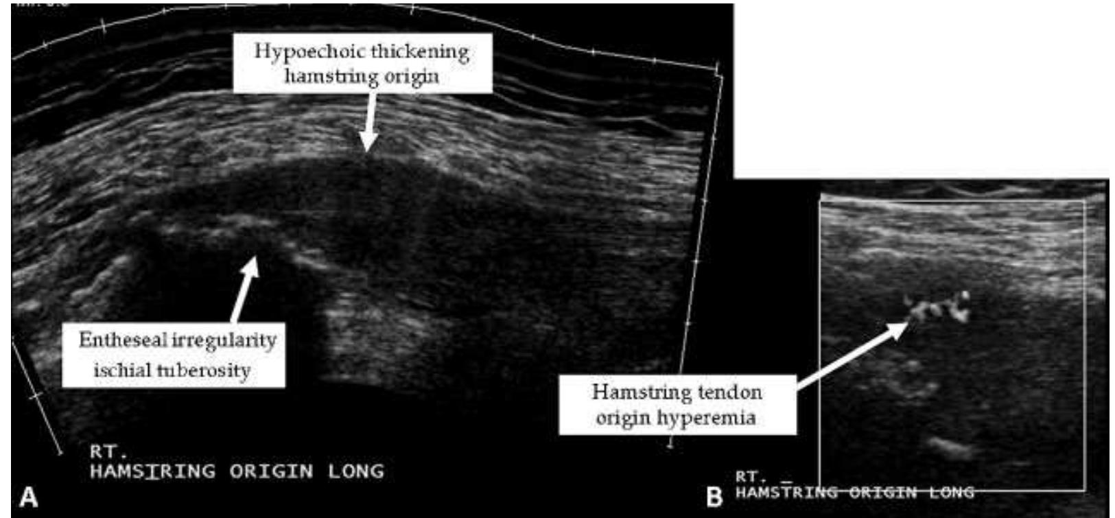 Figure 19 - from Hamstring injuries: anatomy, imaging, and