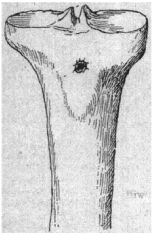 Sketch of a ‘perforating’ wound in tibia by .303 calibre