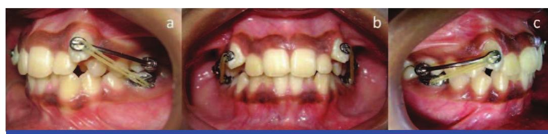 [table/fig-8]: intraoral photographs (carriere distalizer):
