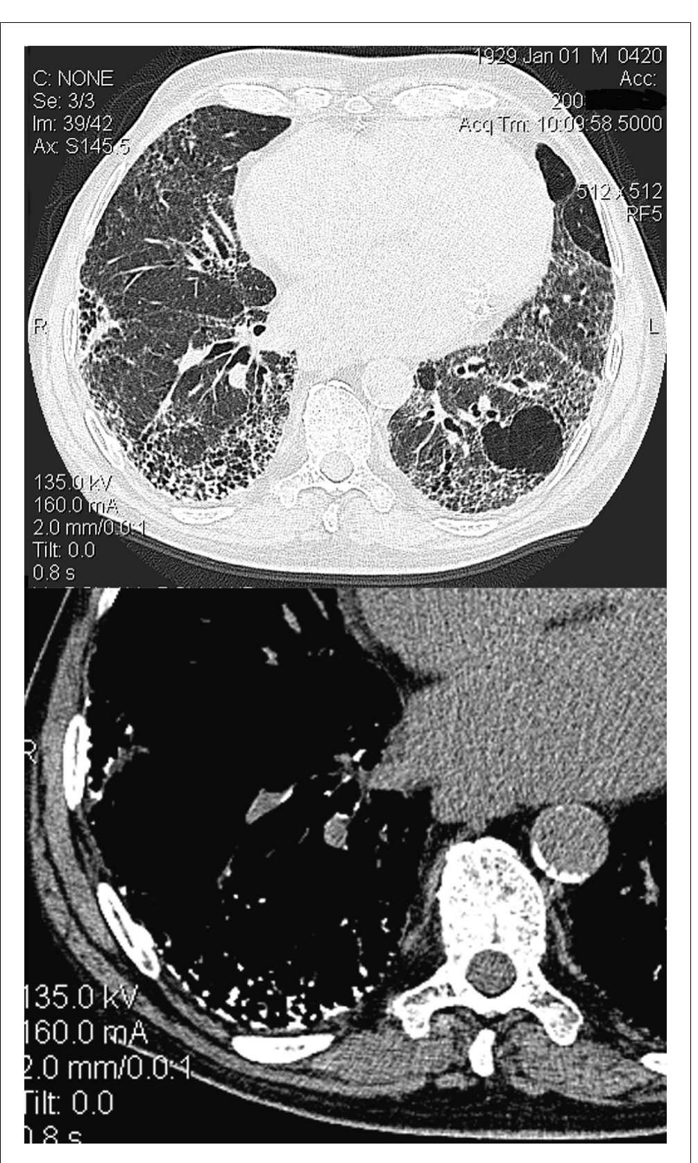 Diffuse Reticular Opacity (PDF) Diffuse pulmonary ossification: an unusual interstitial lung disease