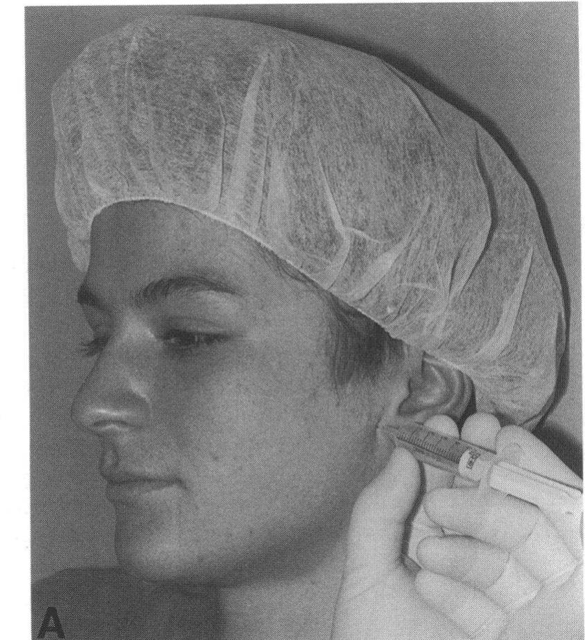 Figure 2 - Techniques of facial nerve block