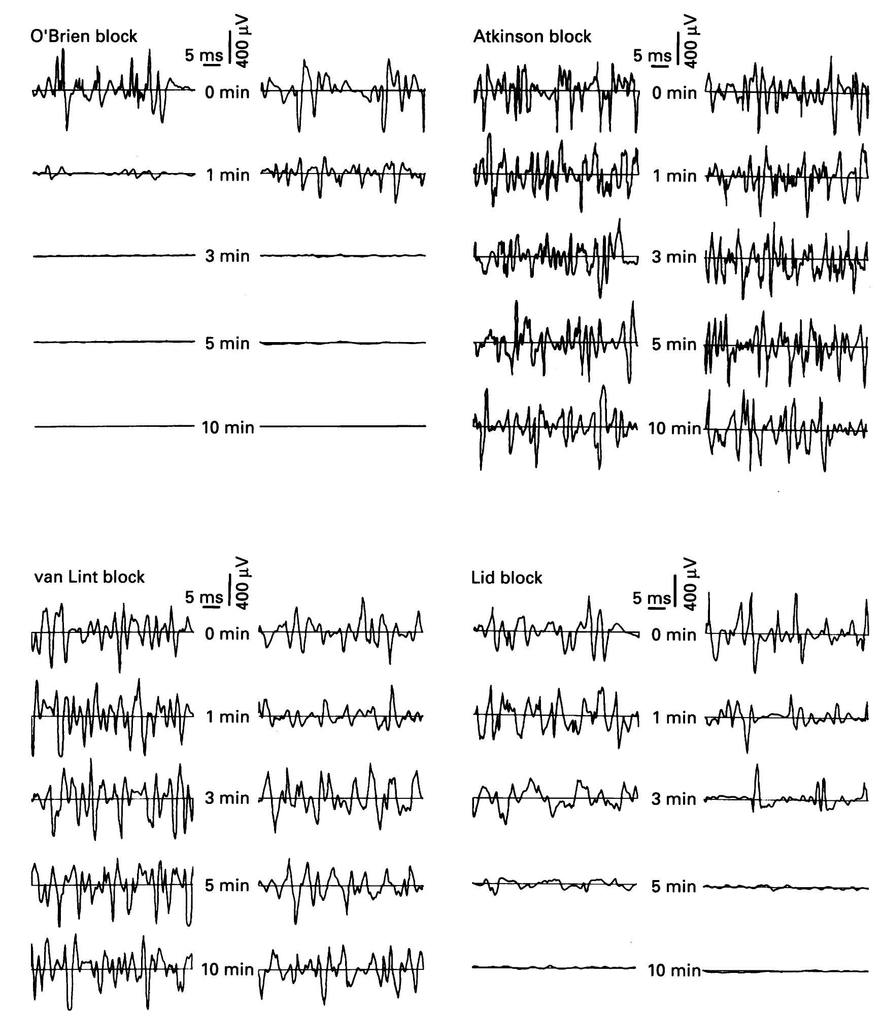 (a) the modified o’brien block: injection at the dorsal rim