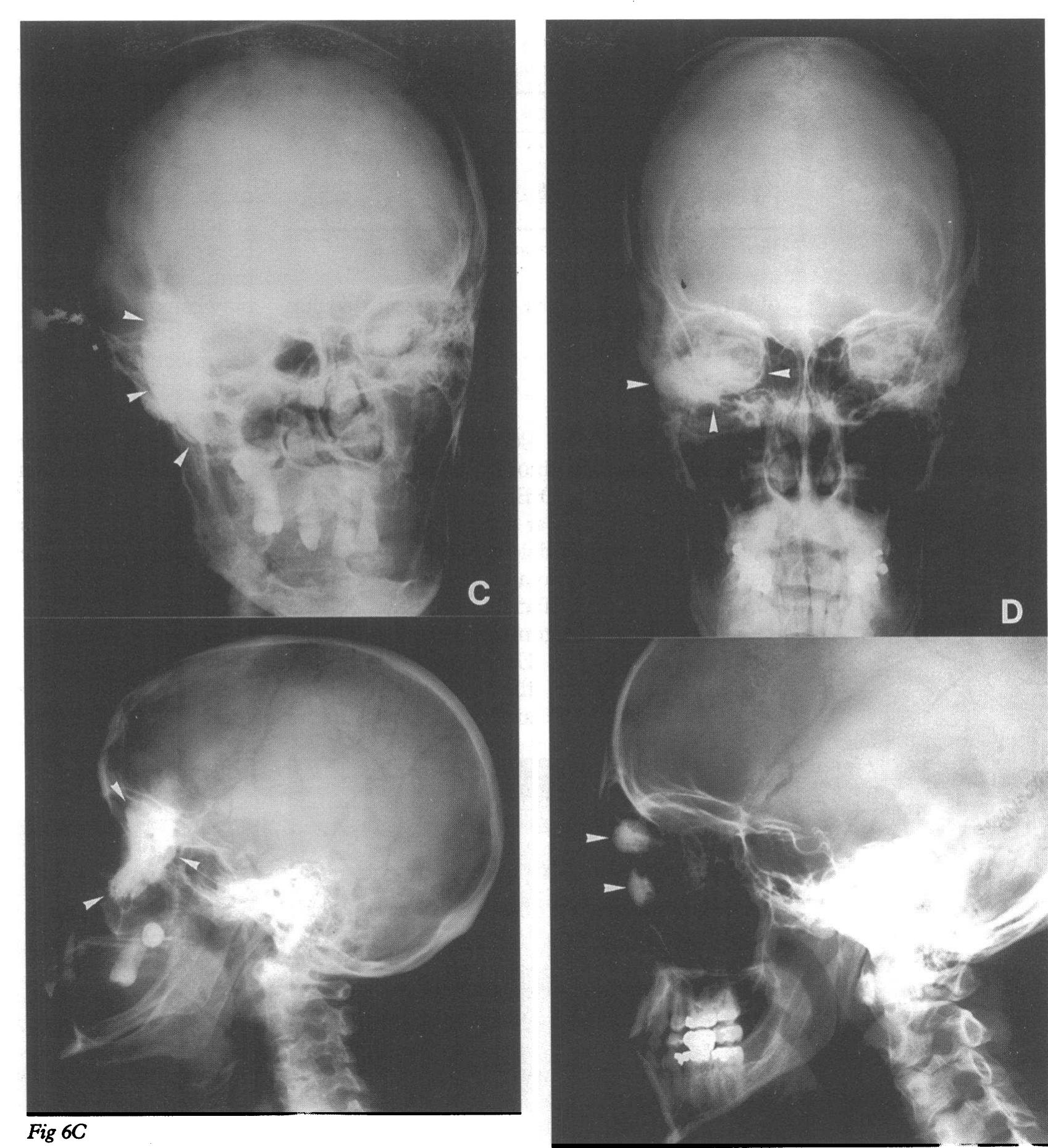 (PDF) Techniques of facial nerve block
